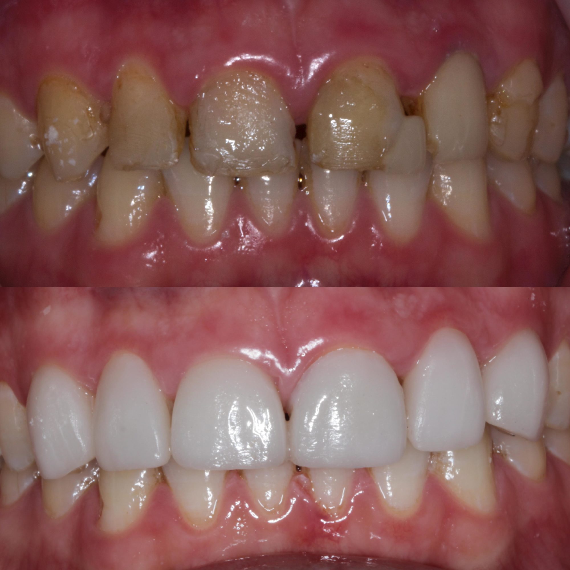 Crowns and Veneers Dr Jessica Round