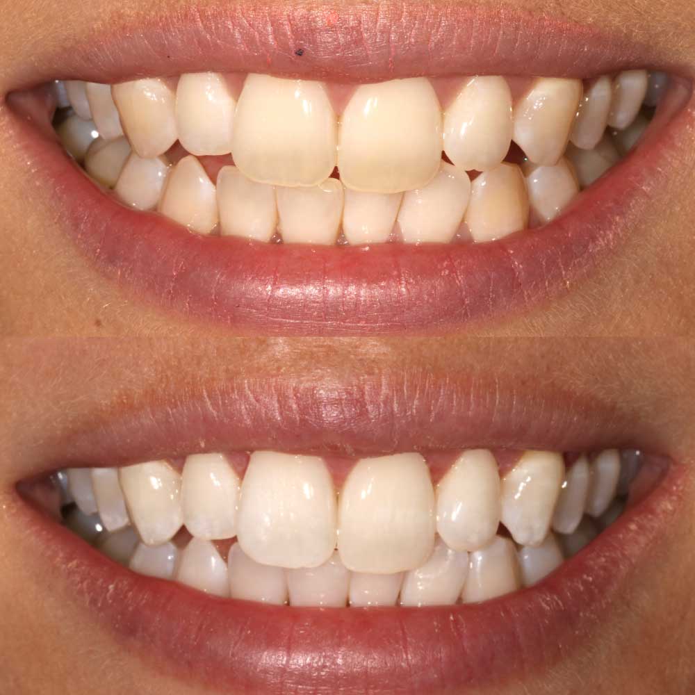 Teeth Whitening