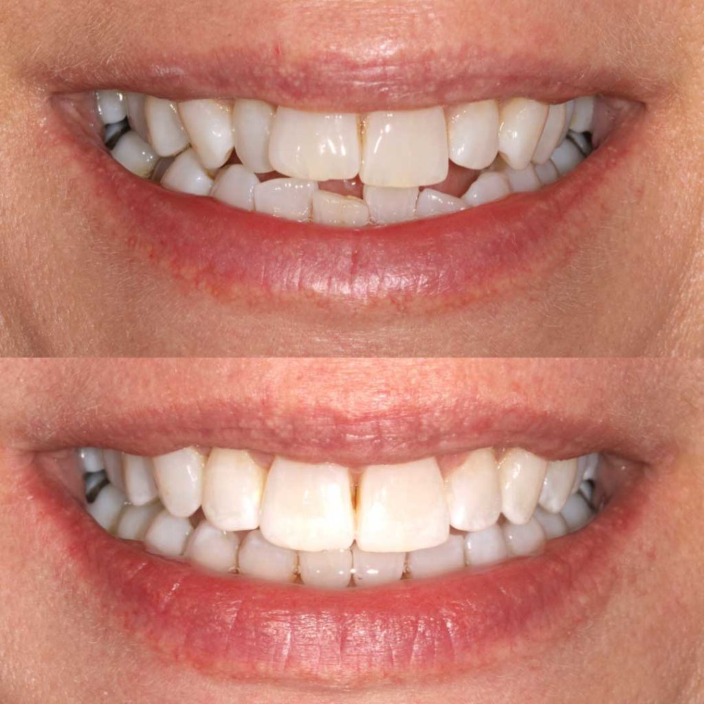 Invisalign