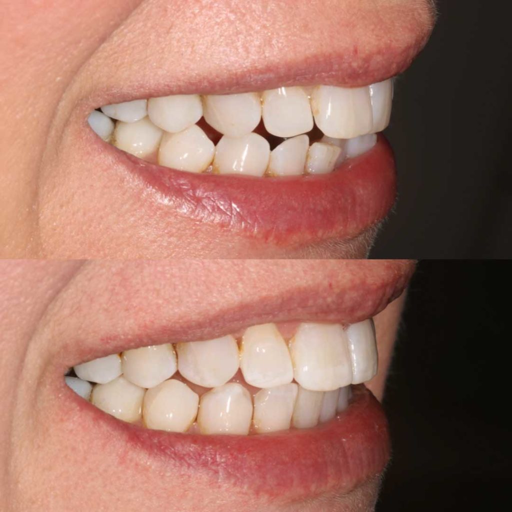 Invisalign