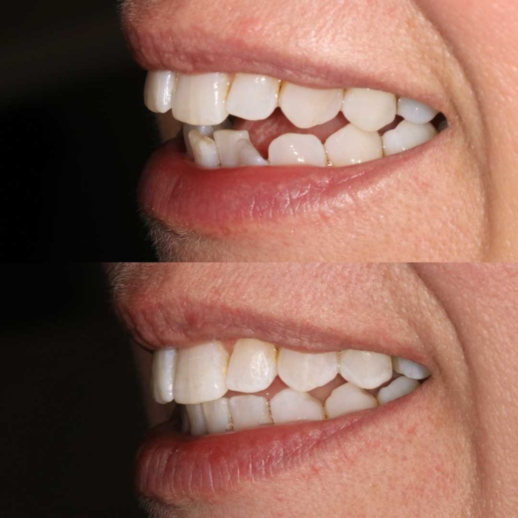 Invisalign